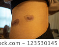 Scar progression after surgery - medical image of abdominal skin regeneration and scar care 123530145
