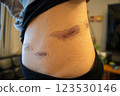 Scar progression after surgery - medical image of abdominal skin regeneration and scar care 123530146