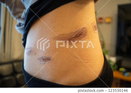 Scar progression after surgery - medical image of abdominal skin regeneration and scar care Scar progression after surgery - medical image of abdominal skin regeneration and scar care 123530146