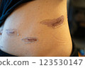 Scar progression after surgery - medical image of abdominal skin regeneration and scar care 123530147