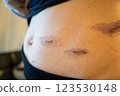 Scar progression after surgery - medical image of abdominal skin regeneration and scar care 123530148