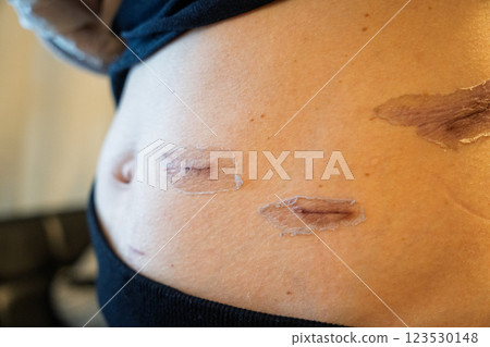 Scar progression after surgery - medical image of abdominal skin regeneration and scar care Scar progression after surgery - medical image of abdominal skin regeneration and scar care 123530148