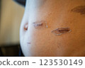 Scar progression after surgery - medical image of abdominal skin regeneration and scar care 123530149