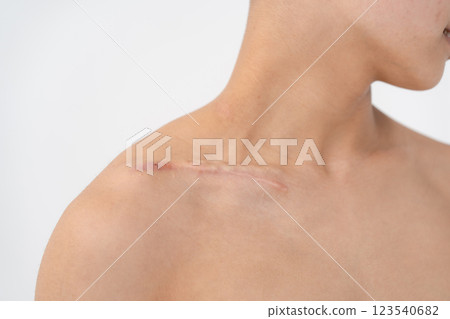 Wound, injury, stitches, scar 123540682