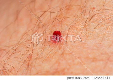 Leg injury in a girl. A severe injury while running in the mountains. 123541614