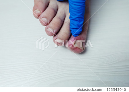 Finger infection. Paronychia, onychomycosis, nail psoriasis, longitudinal melanonychia, onychomadesis and retronychia. Inflammation of the big toe. Treatment of purulent diseases. Finger infection. Paronychia, onychomycosis, nail psoriasis, longitudinal melanonychia, onychomadesis and retronychia. Inflammation of the big toe. Treatment of purulent diseases. 123543040