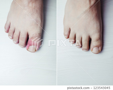 Before and after. Finger infection. Paronychia, onychomycosis, nail psoriasis, longitudinal melanonychia, onychomadesis and retronychia. Inflammation of the big toe. Treatment of purulent diseases. 123543045