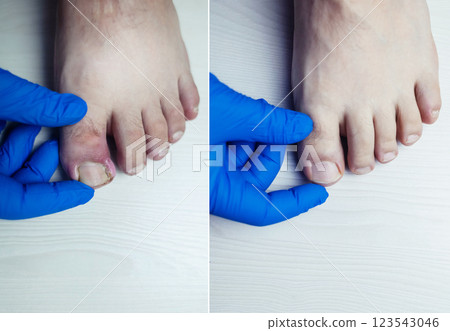 Before and after. Finger infection. Paronychia, onychomycosis, nail psoriasis, longitudinal melanonychia, onychomadesis and retronychia. Inflammation of the big toe. Treatment of purulent diseases. 123543046