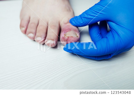 Finger infection. Paronychia, onychomycosis, nail psoriasis, longitudinal melanonychia, onychomadesis and retronychia. Inflammation of the big toe. Treatment of purulent diseases. Finger infection. Paronychia, onychomycosis, nail psoriasis, longitudinal melanonychia, onychomadesis and retronychia. Inflammation of the big toe. Treatment of purulent diseases. 123543048