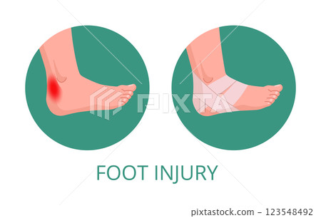 Foot injury medical treatment. Human body part first aid infographic, injured leg part first aid methods flat vector illustration. Cartoon bandaging 123548492