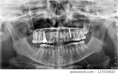 3D panoramic X-ray image of an adult female's teeth with dental implant x-ray image 123550683