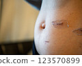 Scar progression after surgery - medical image of abdominal skin regeneration and scar care 123570899