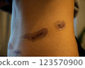 Scar progression after surgery - medical image of abdominal skin regeneration and scar care 123570900