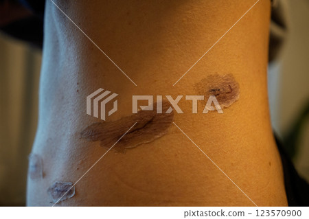 手術後疤痕進展-腹部皮膚再生和疤痕護理的醫學影像 123570900