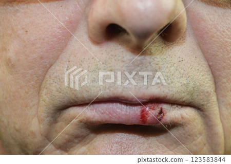 Oral herpes on the lip. Cold sore on the mouth. Fever blister on lips. The concept of health and vitamins 123583844