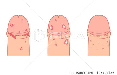 男性生殖器上的腫塊－性傳染病的類型 123594136