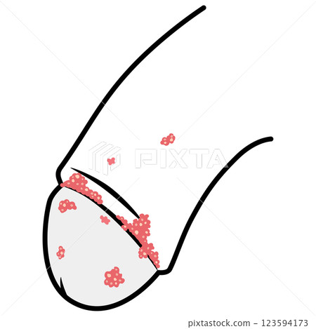 Genital warts: Bumps on the male genitals Genital warts: Bumps on the male genitals 123594173