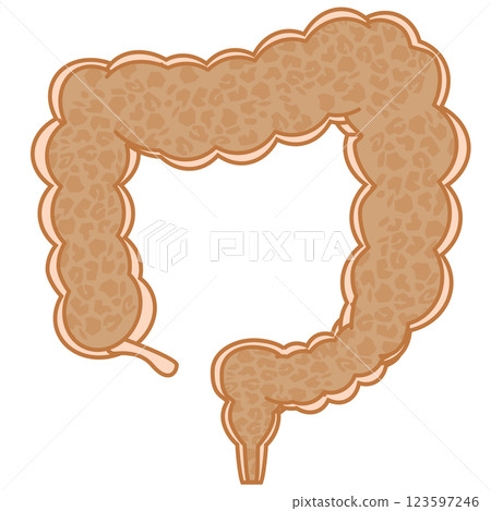 Melanosis coli Melanosis coli 123597246