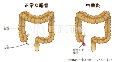 appendicitis illustration appendicitis illustration appendicitis illustration appendicitis illustration 123602177