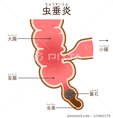 appendicitis illustration appendicitis illustration appendicitis illustration appendicitis illustration 123602179