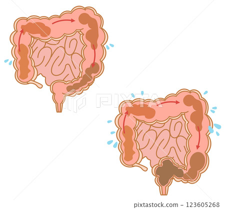 Normal peristalsis and constipated peristalsis of the large intestine Normal peristalsis and constipated peristalsis of the large intestine 123605268