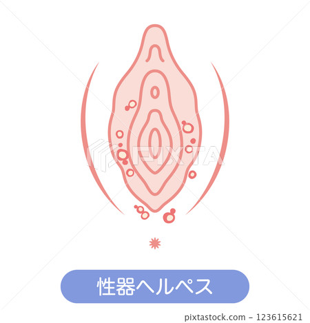 Diseases of the female external genitalia: Genital herpes Diseases of the female external genitalia: Genital herpes 123615621