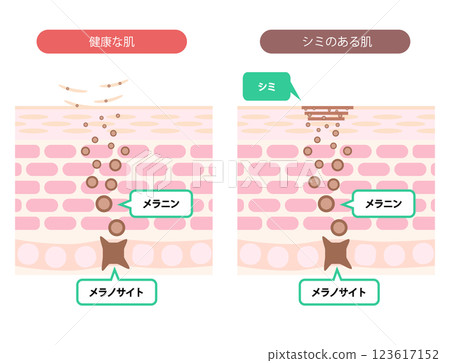 Illustration of blemishes shown on cross-section of skin 123617152