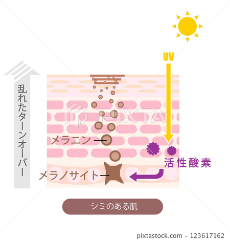 皮膚橫切面上的瑕疵圖示 皮膚橫切面上的瑕疵圖示 123617162