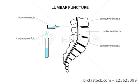 Lumbar puncture spinal tap 123625399