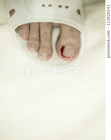 bleeding toe caused by a torn hangnail bleeding toe caused by a torn hangnail 123626541