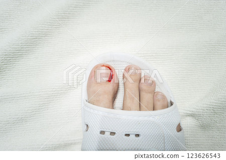 bleeding toe caused by a torn hangnail bleeding toe caused by a torn hangnail 123626543