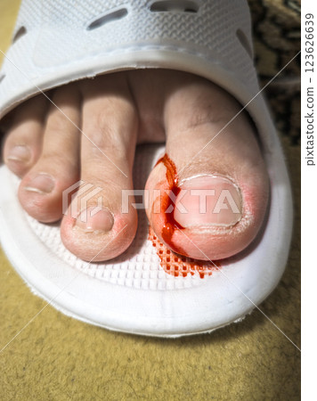 bleeding toe caused by a torn hangnail 123626639