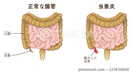 闌尾炎插圖 闌尾炎插圖 123630608