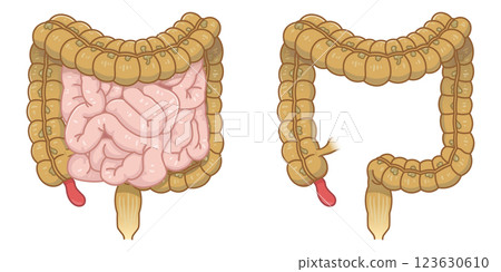 appendicitis illustration appendicitis illustration 123630610
