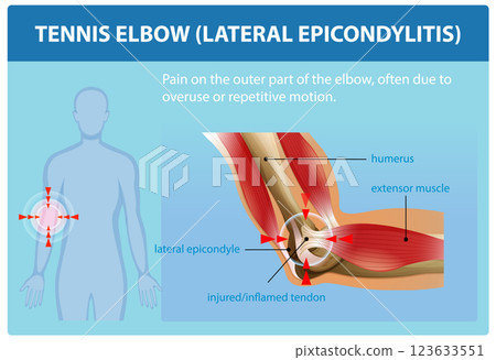 Understanding Tennis Elbow and Its Causes 123633551