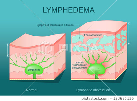 Lymphedema. Cross section of a human skin 123655136