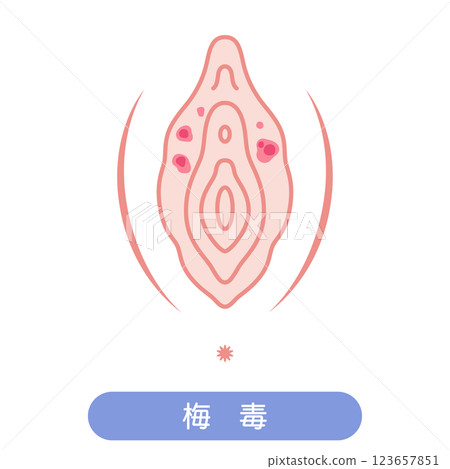 女性外生殖器疾病：梅毒 123657851