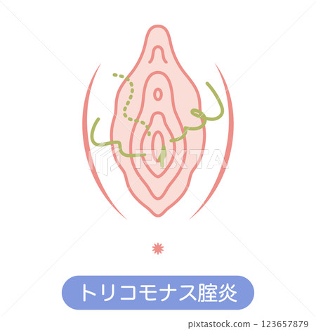 Diseases of the female external genitalia: Trichomonas vaginitis Diseases of the female external genitalia: Trichomonas vaginitis 123657879