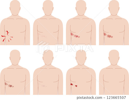 Shingles symptoms. Front view of human upper body. 123665507