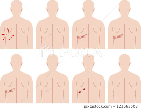 Shingles symptoms. Front view of human upper body. Shingles symptoms. Front view of human upper body. 123665508