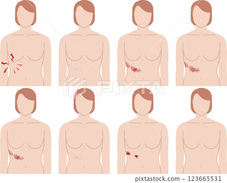 Shingles symptoms. Front view of a woman's upper body. Shingles symptoms. Front view of a woman's upper body. 123665531