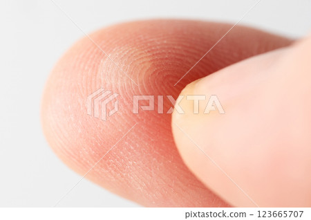 Injured with blister human finger Injured with blister human finger 123665707