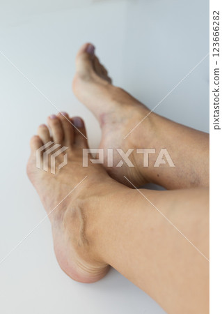 Large swollen vein on the female foot. Varicose veins, closeup. 123666282