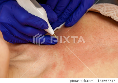 Removal of papillomas on the body Removal of papillomas on the body 123667747