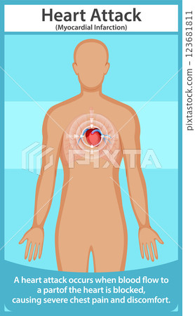 Understanding Heart Attack Symptoms and Causes Understanding Heart Attack Symptoms and Causes 123681811