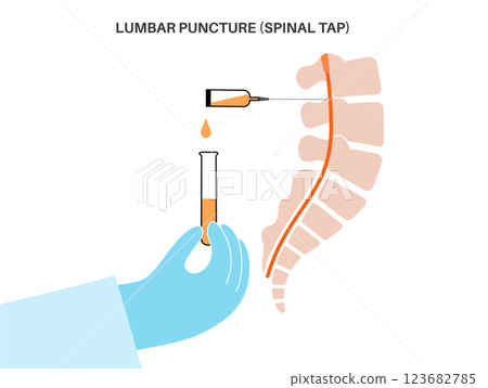 Lumbar puncture spinal tap 123682785