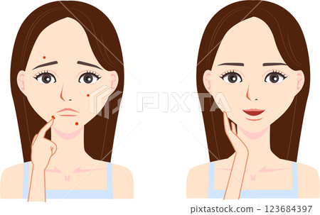 遭受粉刺的婦女的例證 123684397