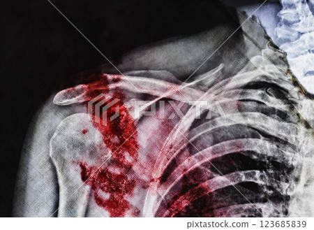 X-ray and stains of blood X-ray and stains of blood 123685839