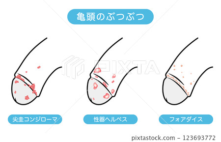 男性生殖器上的腫塊－性傳染病的類型 123693772