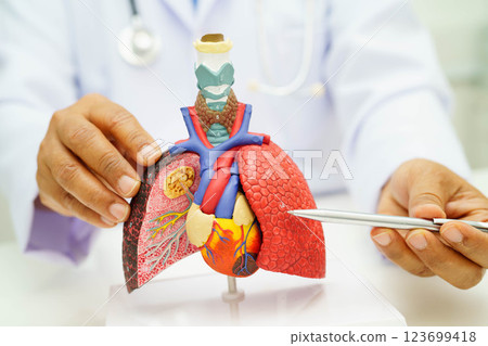 Cirrhosis, Liver cancer, fatty liver, Asian woman with liver human anatomy model. 123699418